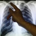 Homme on ülemaailmne tuberkuloosipäev, Eestis haigestus mullu tõppe 175 inimest