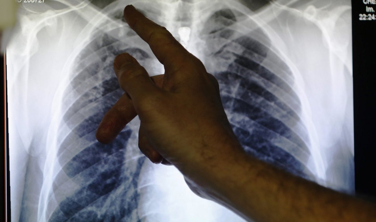 Tuberkuloosihaige kopsudest tehtud röntgenpilt. 