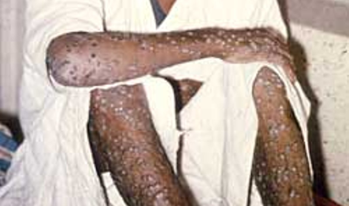 EBAMEELDIV MEENUTADA: Viimane kord nakatuti rõugetesse Somaalias oktoobris 1977.