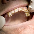 Hambaarst hammaste tervisest: miks meil ikkagi on nii kehvad hambad?
