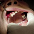 Moodne paleodieet hambaaukudest ei päästa