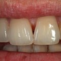Kui ühel osapoolel on hambaaugud, kas see võib ka teist nakatada?