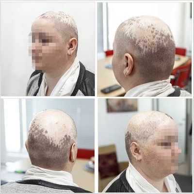 После первых операций: часть пересаженных волос уже прижилась на голове