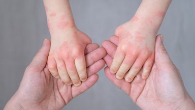 Kas allergiatest võib välja kasvada? Allergoloog vastab kuuele enim esitatud küsimusele allergiate kohta