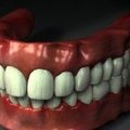 Kuidas toimivad hambaimplantaadid?