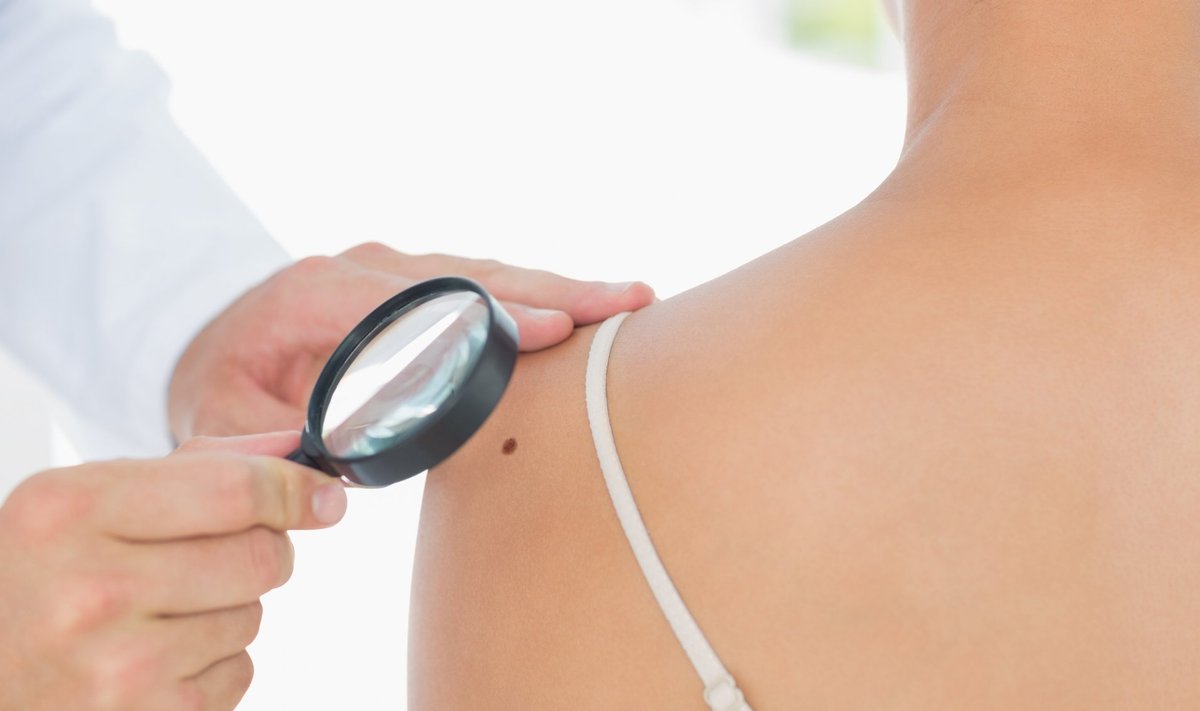 Uuringutest ilmneb, et enesevaatluse abil väheneb suremus melanoomi 63%.
