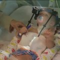VIDEO: Austraalia arstid kinnitasid lapse eraldunud pea uuesti selgroo külge