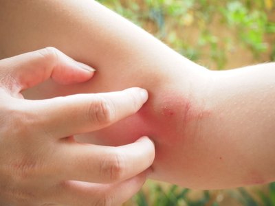 Putukahammustustest tingitud allergianähte leevendavad nii välis- kui seespidised vahendid.