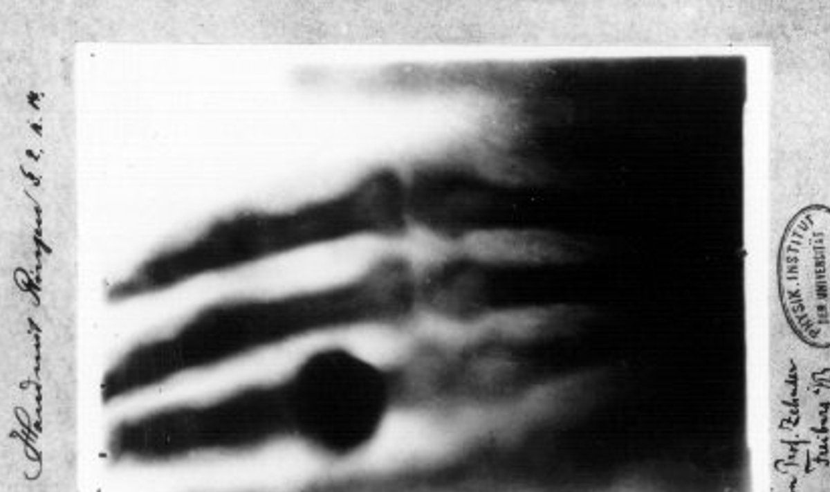 Esimene röntgenfoto Wilhelm Röntgeni abikaasa Anna-Bertha käest.