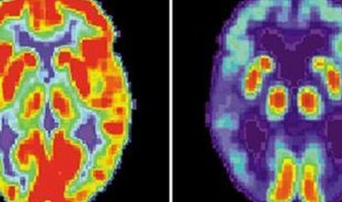 Terve inimese (vasakul) ja Alzheimerit põdeva inimese ajuskaneering (paremal). 