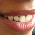 Hammaste tervis: pärilikud hambumuse probleemid — ravida või mitte?