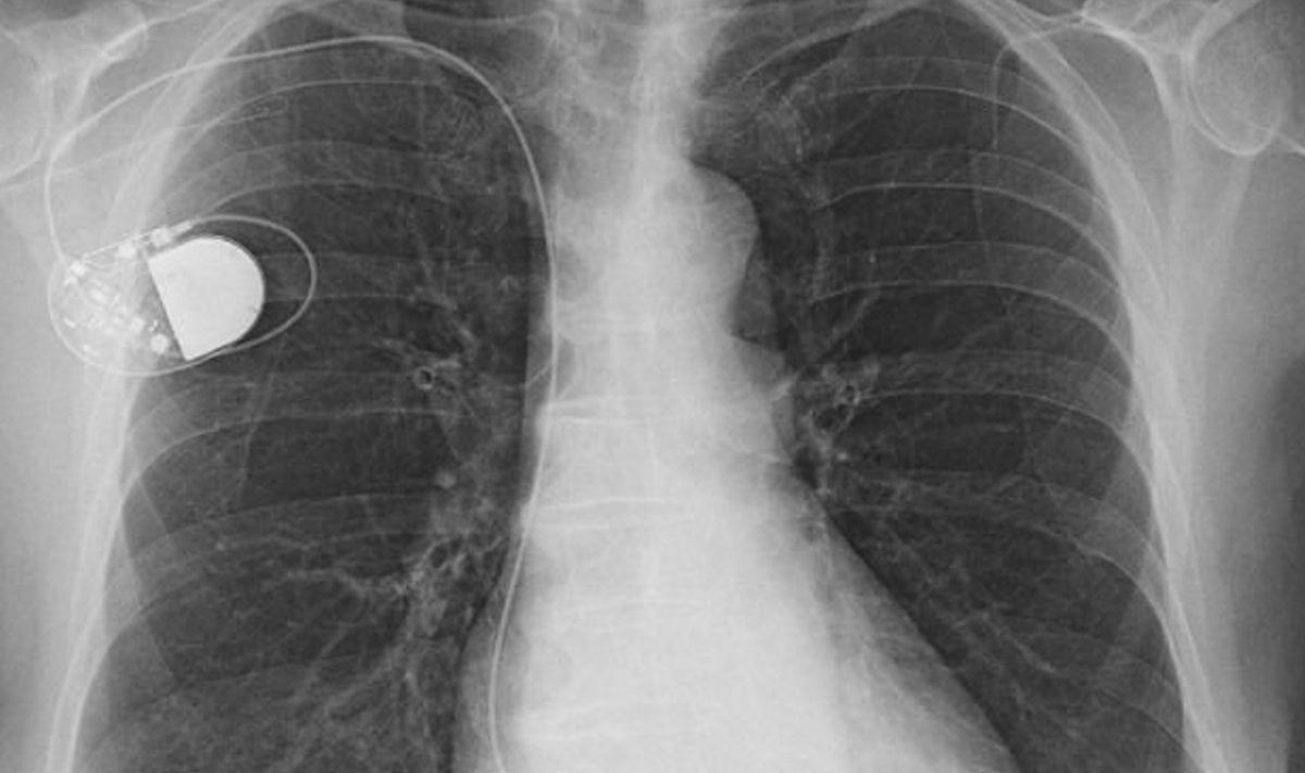 Röntgenipilt rinnakorvist ja südamestimulaatorist. (Foto: Wikimedia Commons / Th. Zimmermann, THWZ)
