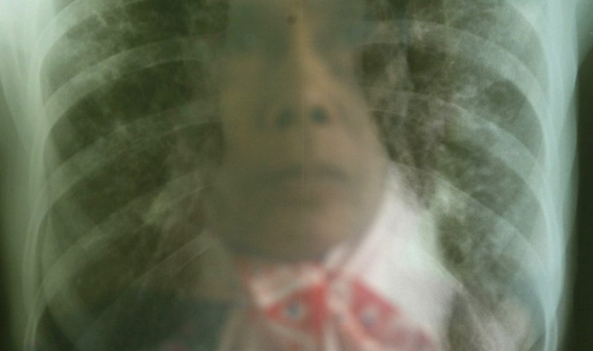 Tuberkuloosi kahtlusega patsient oma röntgenpilti uurimas. Foto Yusuf Ahmad, Reuters