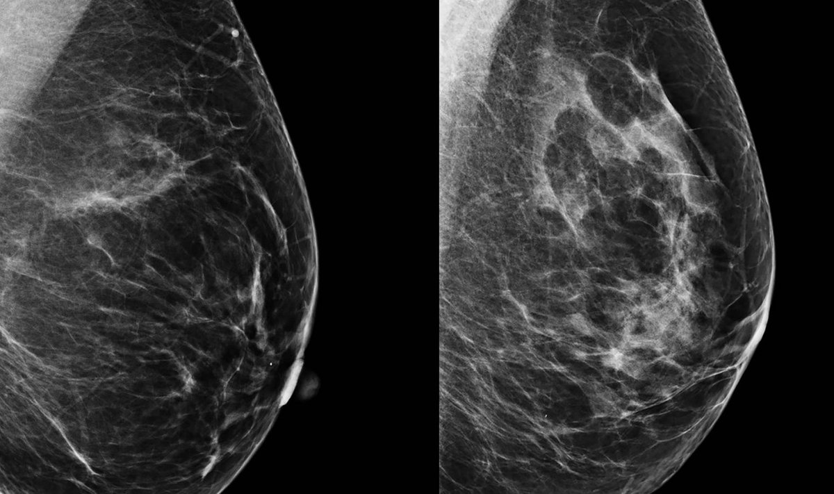 Pildid on näiliselt sarnased. Tehisintellekti abiga suudeti täpselt tuvastada, et vasakpoolse pildi alusel rinnavähi riski naisel ei ole. Parempoolse pildi alusel tuvastati patsiendil aga kõrge vähirisk ning sel naisel diagnoositi viie aasta pärast rinnavähk.