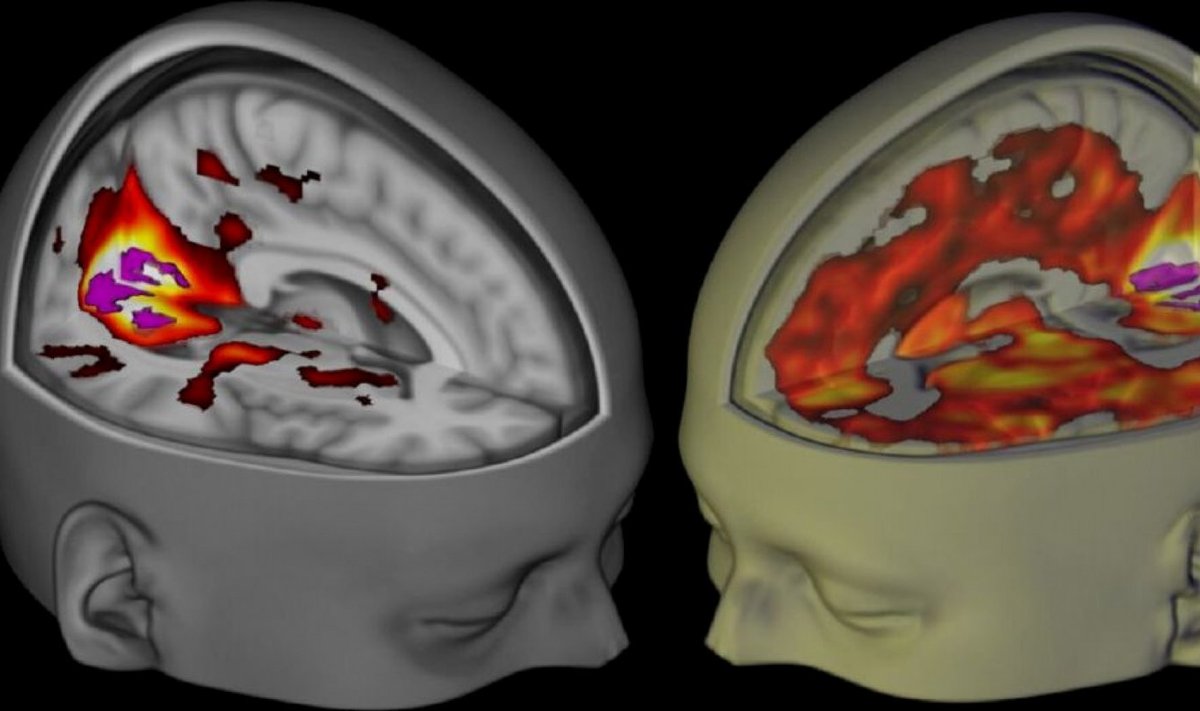 Uuringus osaleja aju platseeboga (vasakul) ja LSD-ga. (Foto: REUTERS)