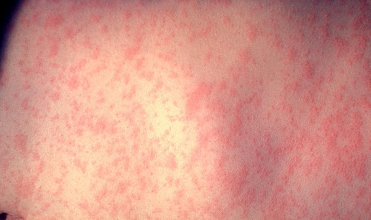 Leetripatsiendi nahk haiguse kolmandal päeval.