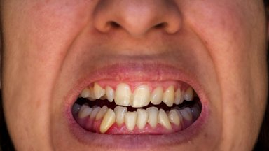 VIDEO | Millal sina viimati hambaarsti juures käisid? Eesti inimestel on üllatuslik põhjus, miks arsti juurde minemisega viivitatakse